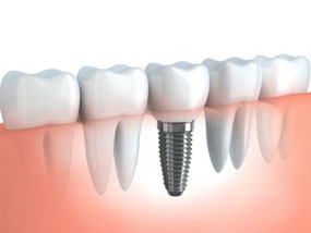 Implant Restoration | Dr. O'Leary | Dentist Peabody MA