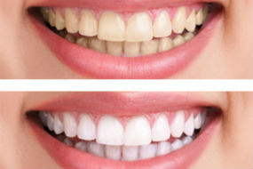 Teeth Whitening Available | Dr. O'Leary | Peabody MA Dentist